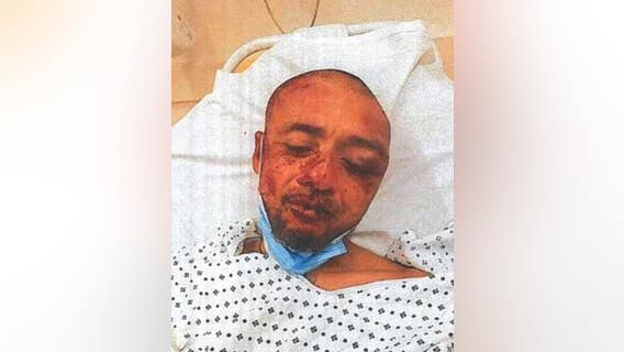 Charges dismissed against man whose face was fractured while being detained by San Francisco cops