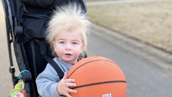 Georgia toddler diagnosed with extremely rare uncombable hair syndrome