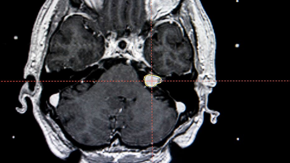 Acoustic Neuroma, Mri