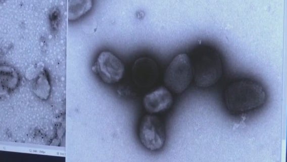 Person who was isolated at SF jail tests negative for monkeypox