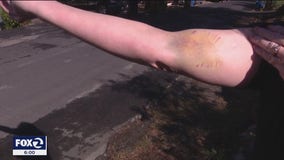 Dog bites and attacks woman weeks after dangerous animal designation dropped
