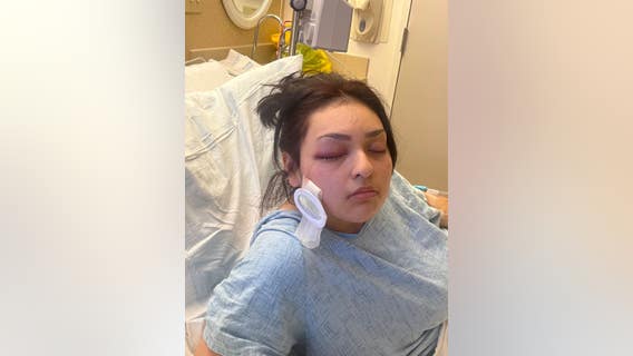 Antioch Habit Burger manager loses eye in attack; suspect on the loose