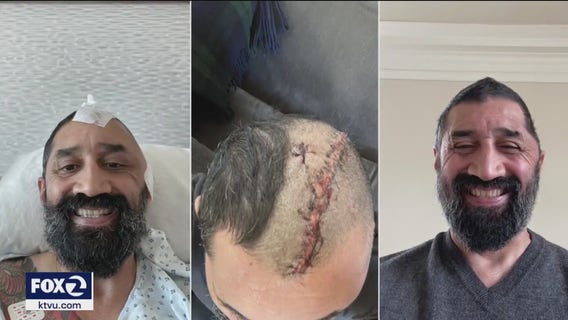 San Francisco man left with broken skull, brain injury fighting release of his alleged assailant