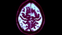 Avoiding these 3 things during midlife could ward off dementia