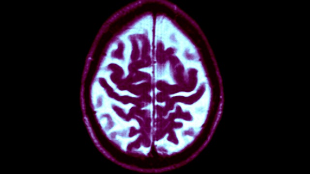 Avoiding these 3 things during midlife could ward off dementia