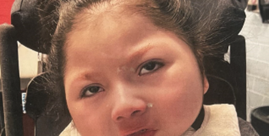 5-year-old disabled boy suffers life-threatening burns in Santa Rosa fire