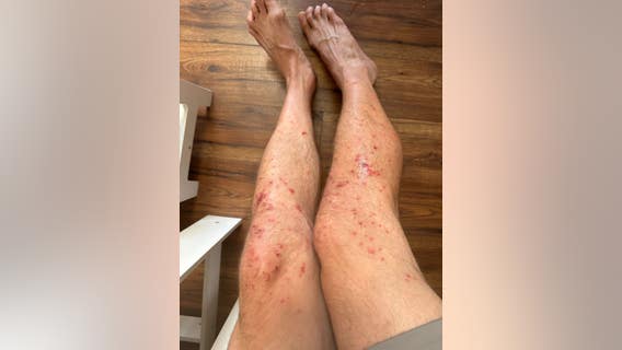 Tough Mudder athletes complain of rash after Sonoma County race