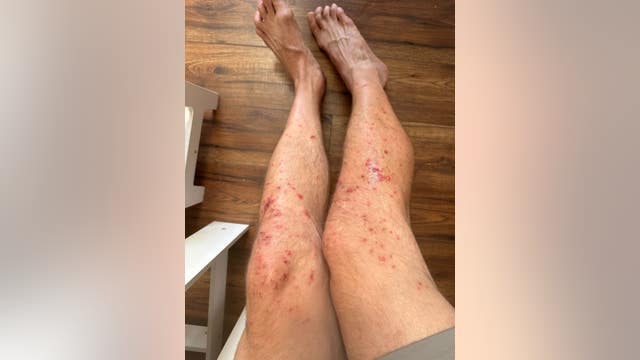 Tough Mudder athletes complain of rash after Sonoma County race