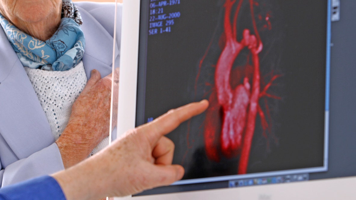 No more statins? One-time treatment for high cholesterol could lower heart attack risk for life