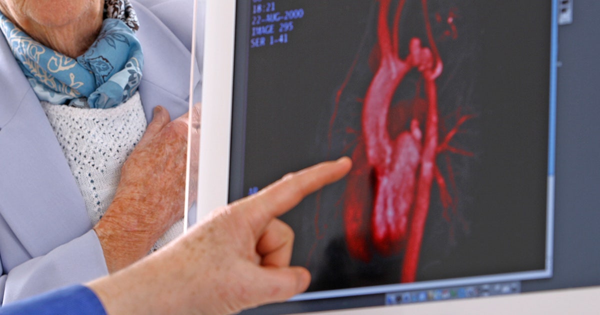 No more statins? One-time treatment for high cholesterol could lower heart attack risk for life