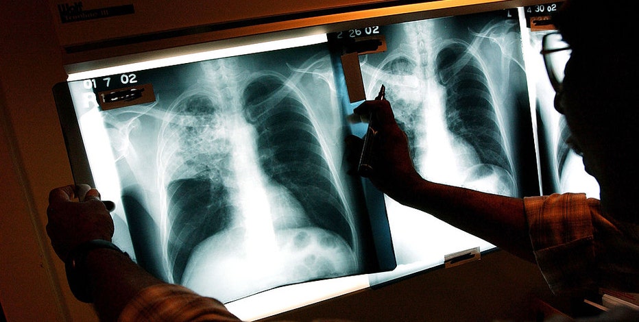 Cache Creek Casino and Resort alerts of contagious tuberculosis