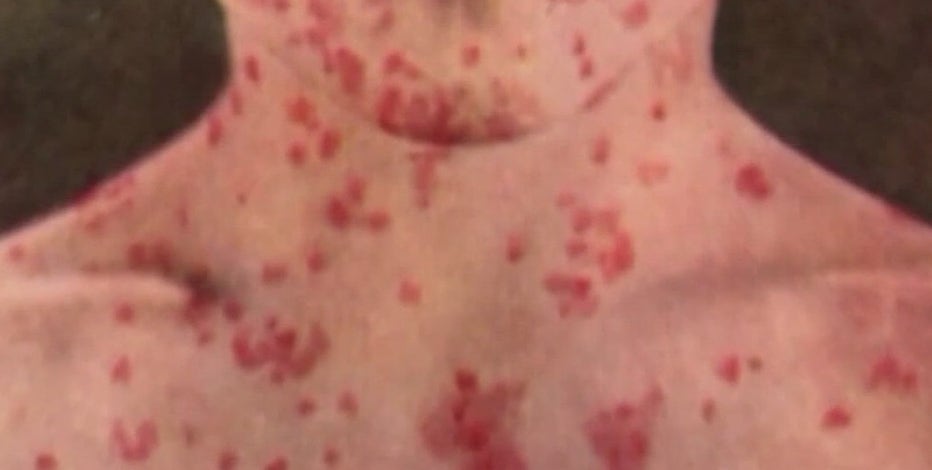 Bay Area health officials warn about uptick in measles cases nationwide