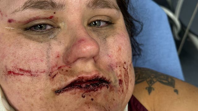 Woman recovering from brutal, unprovoked attack in Oakland