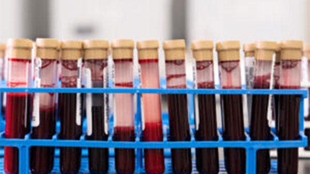 Groundbreaking blood test can detect more than 50 cancers, Bay Area biotech says