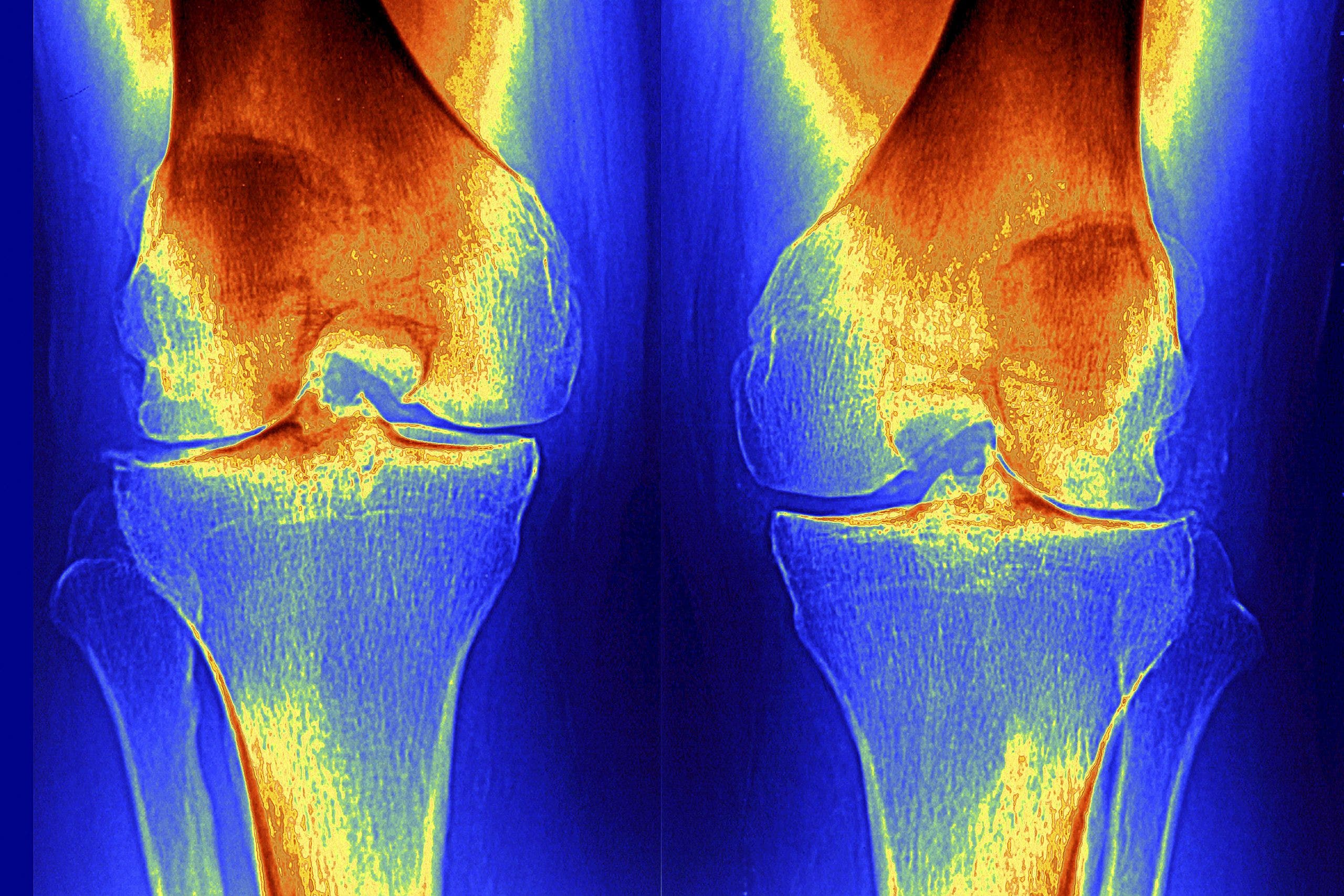 Stunning Stanford study finds way to regrow joint cartilage. Could it mean an end to osteoarthritis?