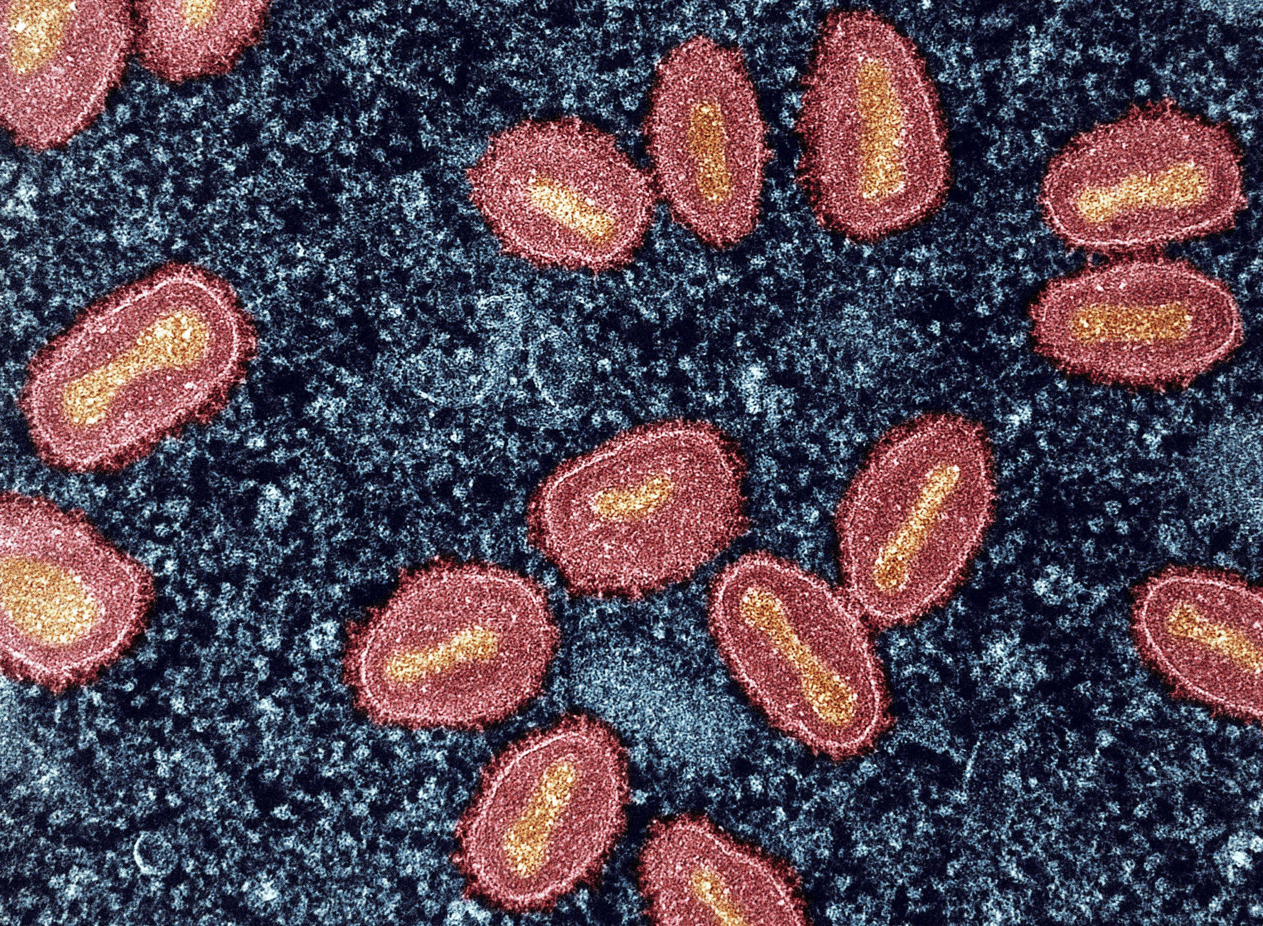 SF Department of Public Health confirms first clade I mpox case