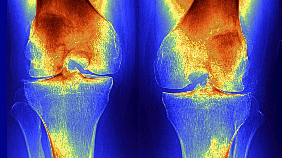 Stunning Stanford study finds way to regrow joint cartilage. Could it mean an end to osteoarthritis?