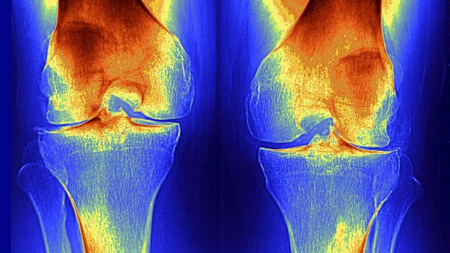 Stunning Stanford study finds way to regrow joint cartilage. Could it mean an end to osteoarthritis?