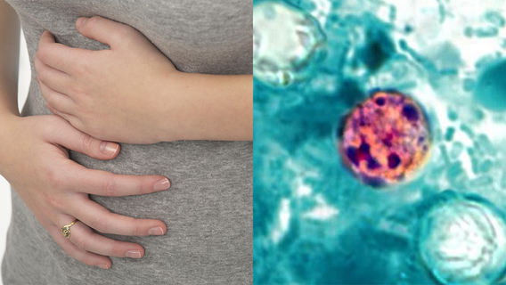 Cyclosporiasis: California now reporting cases of parasite causing 'explosive diarrhea'