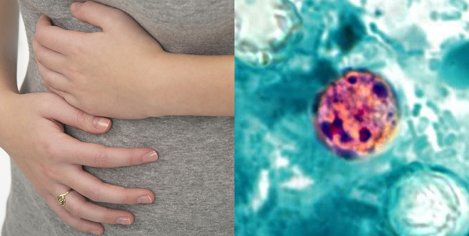 Cyclosporiasis: California now reporting cases of parasite causing 'explosive diarrhea'