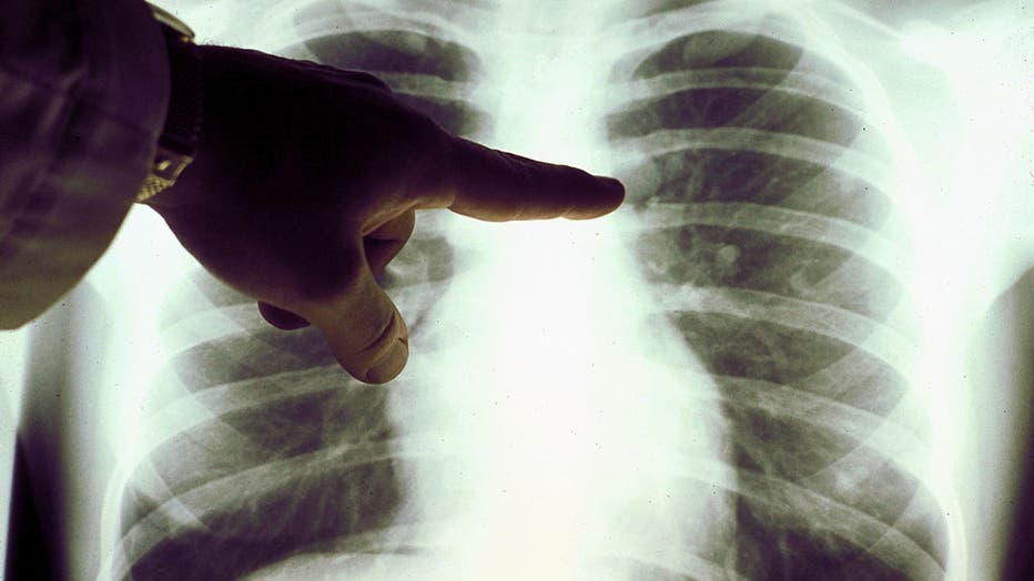 FILE - A view of a close-up of a lung x-ray of a cigarette smoker in an undated photo. (Photo Courtesy of the American Cancer Society via Getty Images)