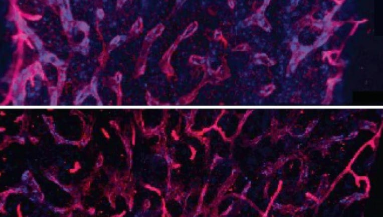 The researchers found that an inflammatory signal released from old bone marrow, IL-1B, was critical in driving aging in blood stem cells. The drug, anakinra, returned the blood stem cells to a younger, healthier state. (Images of young (top) and old bone marrow courtesy of Emmanuelle Passegué.)