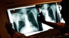 Tuberculosis cases continued climbing in 2023
