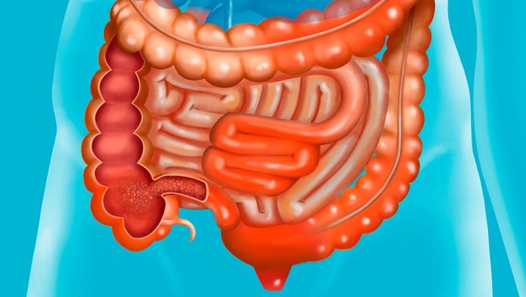 FILE - An illustration of Crohns Disease (Photo By BSIP/UIG Via Getty Images)