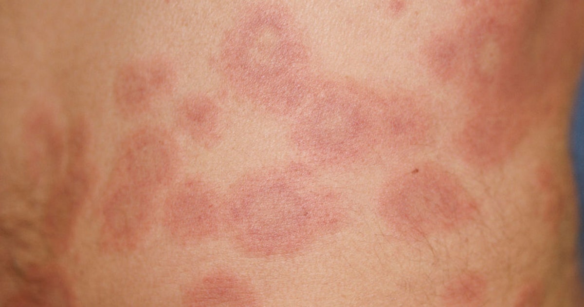 lupus  Lupus.jpg?ve=1&tl=1