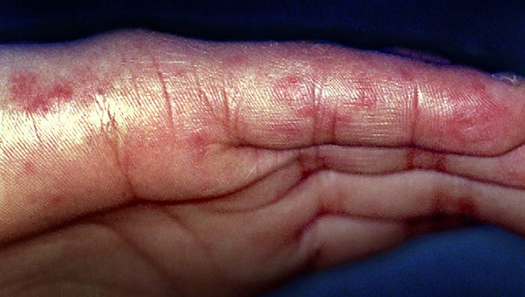 FILE - Systemic lupus erythematosus (autoimmune disease) with inflammatory skin of the fingers. (Photo by: CAVALLINI JAMES/BSIP/Universal Images Group via Getty Images)