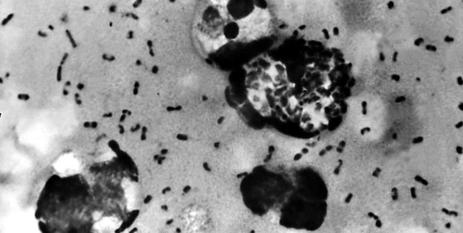 Human plague case confirmed in Colorado, health officials warn