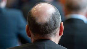 Cure for men's hair loss could be found in sugar stored in the body, study suggests