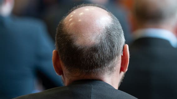 Cure for men's hair loss could be found in sugar stored in the body, study suggests