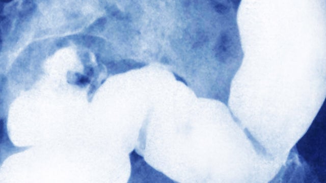 Terminal colon cancer patient saved by breakthrough treatment