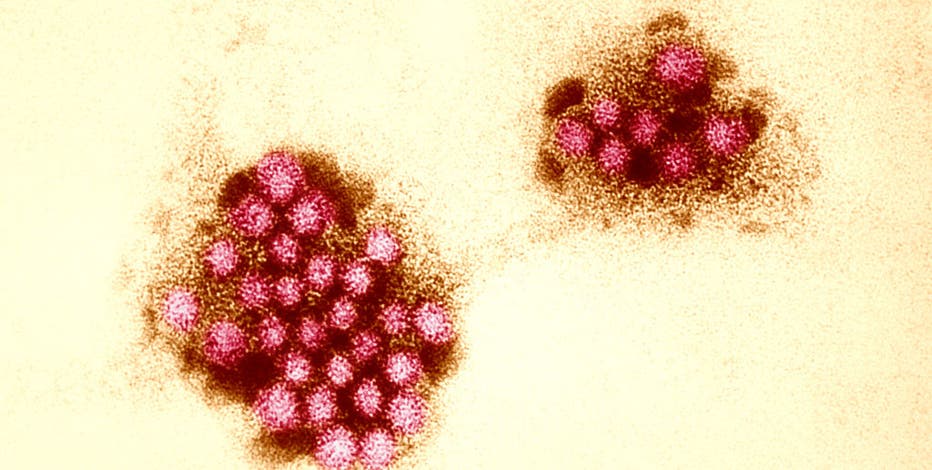 Norovirus outbreaks surge across US: What you need to know