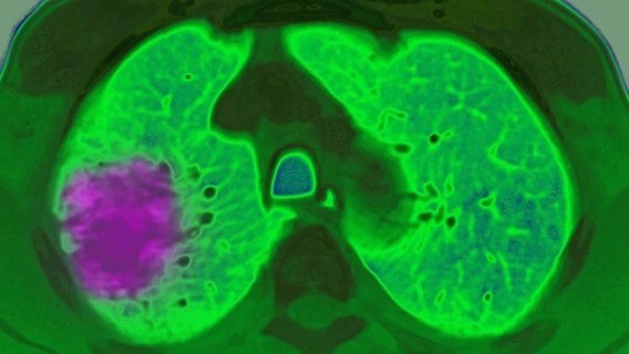 Lung cancer rising among non-smokers — here's why