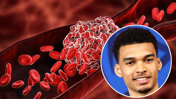 What is DVT, the condition that sidelined Victor Wembanyama?