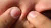 Popular acne products recalled after high levels of benzene found: What to know