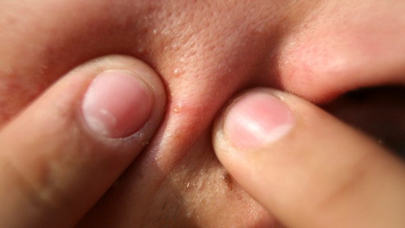 Popular acne products recalled after high levels of benzene found: What to know