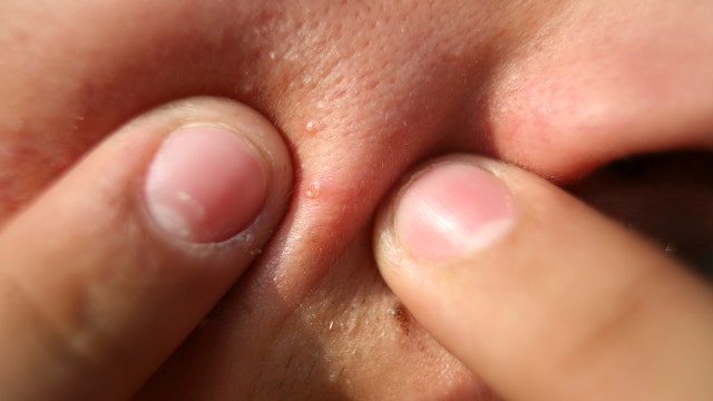 Popular acne products recalled after high levels of benzene found: What to know