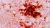 3 cases of rare brain disease found in Oregon; 2 deaths reported