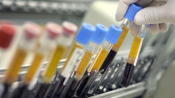 New blood test unveiled to enhance detection of common cancers