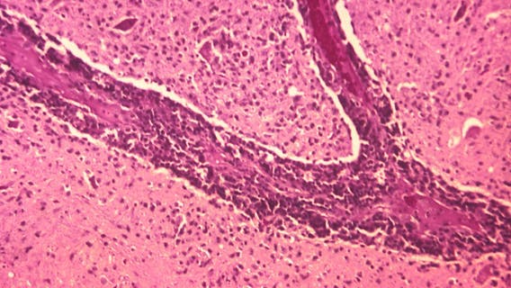 Person dies of rabies after contracting virus from transplanted organ in Ohio