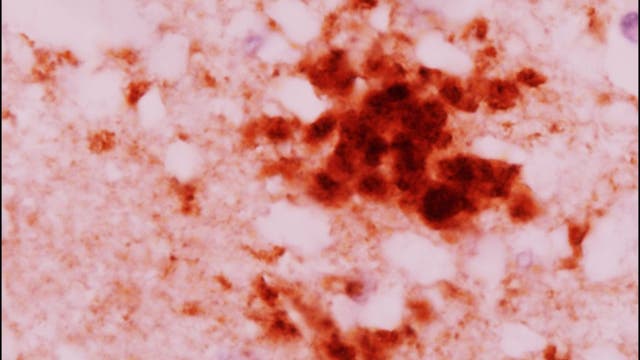 3 cases of rare brain disease found in Oregon; 2 deaths reported