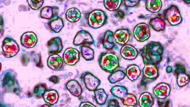 Measles update: These 5 states now have active outbreaks