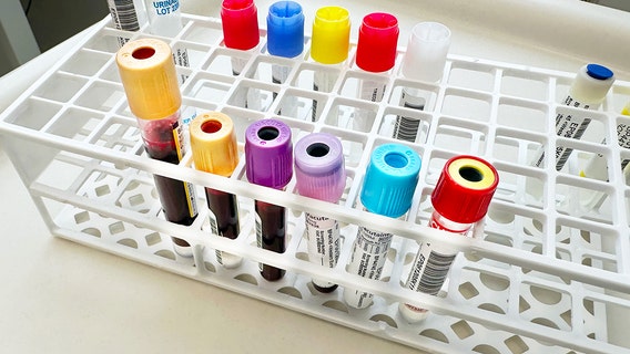 Cancer could be detected three years before diagnosis with experimental blood test