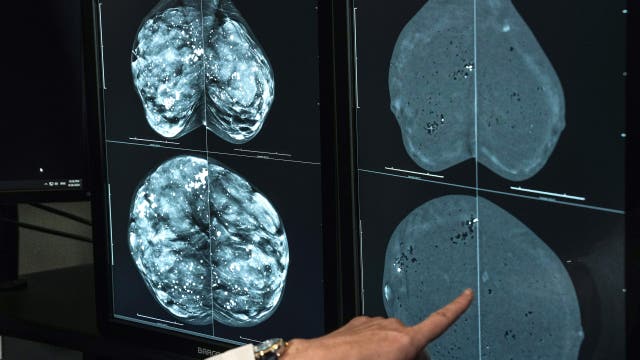 FDA approves first AI tool to predict breast cancer risk