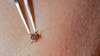 ER visits for tick bites are at their highest level in years: Here's where