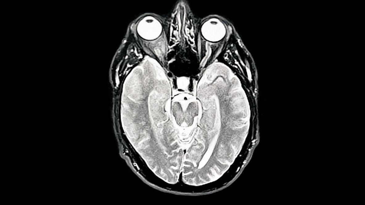 Study reveals new ways to predict onset of Alzheimer’s disease