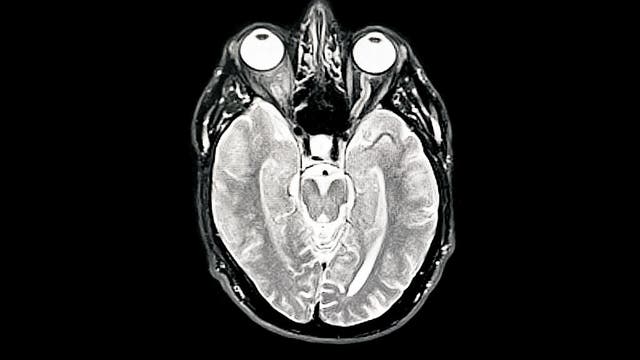 Study reveals new ways to predict onset of Alzheimer’s disease